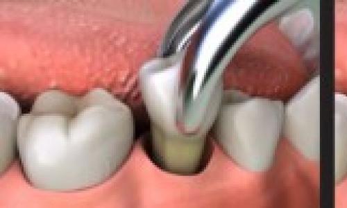 Удаление зубов детям под наркозом Можно удалять молочные