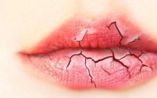 Suha usta - uzroci, bolesti, metode eliminacije i liječenja