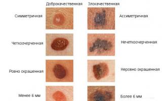 त्वचा कैंसर की पहचान कैसे करें: पहला लक्षण और लक्षण त्वचा कैंसर क्या होता है