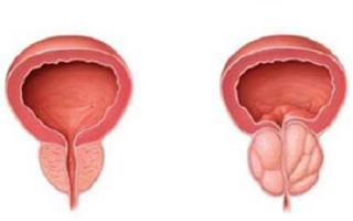 Šta je adenom prostate kod muškaraca: simptomi, liječenje, lijekovi i prevencija Kako liječiti prostatitis i adenom prostate