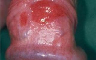 Balanitis (inflammation of the glans penis)