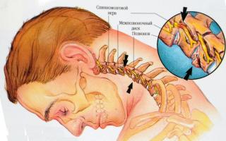 Liječenje osteohondroze vratne kičme lijekovima