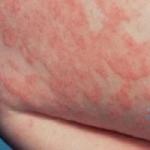 Children's dermatitis: why does it occur, what does it look like, what is dangerous and how to treat it?