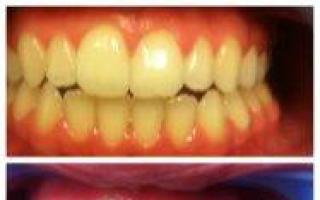 Tablete za zubobolju - brzo i efikasno