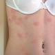 Mrlja s crvenim rubom na koži: mogući uzroci i značajke liječenja Blijede mrlje sa crvenim rubom