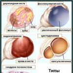 Varieties, symptoms and treatment of ovarian cysts in women, preventive measures