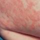 Detská dermatitída: prečo sa vyskytuje, ako to vyzerá, čo je nebezpečné a ako ju liečiť?