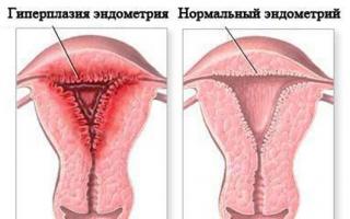 Hyperplázia endometria v menopauze