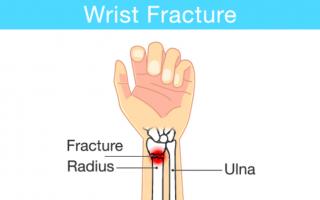Symptoms, treatment and restoration of the radius of the arm after a fracture Displaced fracture of the radius without surgery