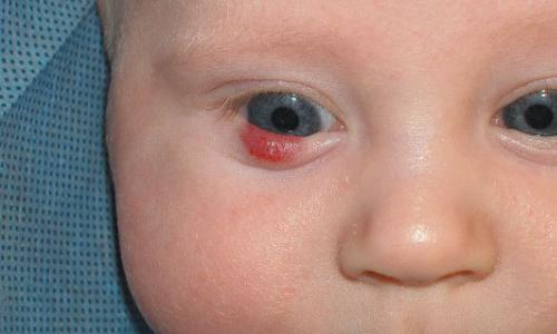 How to identify hemangioma in a child and treat it correctly Symptoms of a tumor on the eyelid